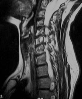Cervical Spinal Stenosis Mri