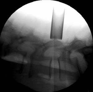 X-ray minimally invasive herniated disc surgery