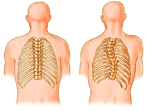 Anatomy drawing of Adult Idiopathic Scoliosis
